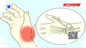 手腕疼痛 當(dāng)心患上“媽媽手”