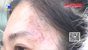 美容差點(diǎn)變毀容 愛(ài)美人士需謹(jǐn)慎