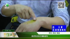 燒燙傷后抹牙膏靠譜嗎