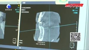 牙齒缺失怎么辦 口腔專家表示：應(yīng)及時修復(fù)