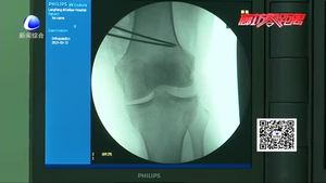 廊坊首例3d技術(shù)手術(shù) 實(shí)現(xiàn)手術(shù)“私人訂制”