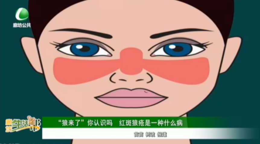 “狼來了”你認(rèn)識嗎 紅斑狼瘡是一種什么病