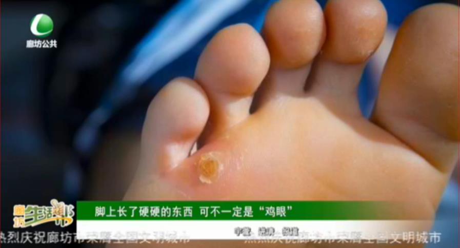 腳上長(zhǎng)了硬硬的東西 可不一定是“雞眼”
